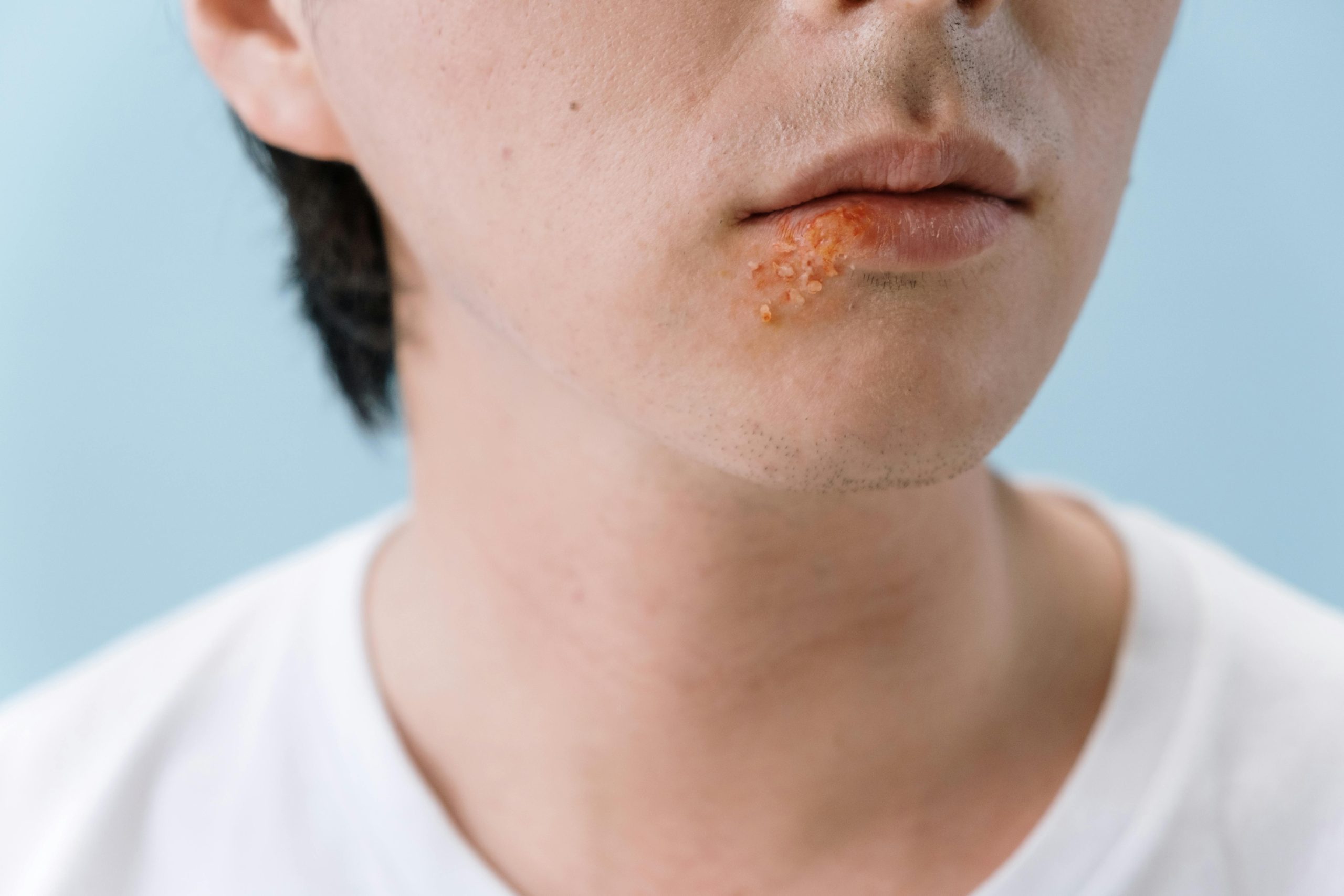 A close-up image of a person's lips showing a cold sore on the lower lip area. Un gros plan d'une personne montrant un bouton de fièvre sur la lèvre inférieure.
